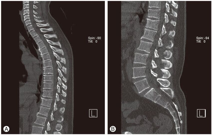 Deformation of the intervertebral discs on MRI images in thoracic osteochondrosis