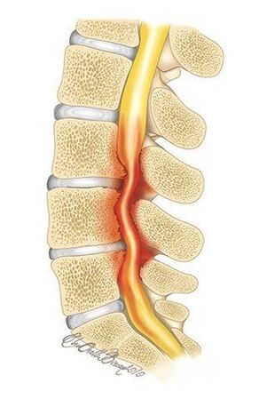 With osteochondrosis of the thoracic spine, there is compression of the spinal canal