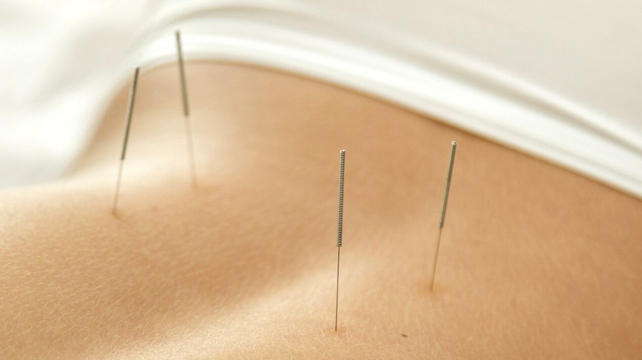 Acupuncture helps get rid of lower back pain
