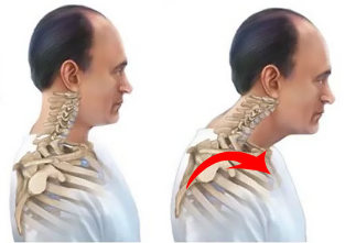 sick and healthy spine