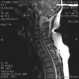 Osteochondrosis and spondylosis of the cervical spine
